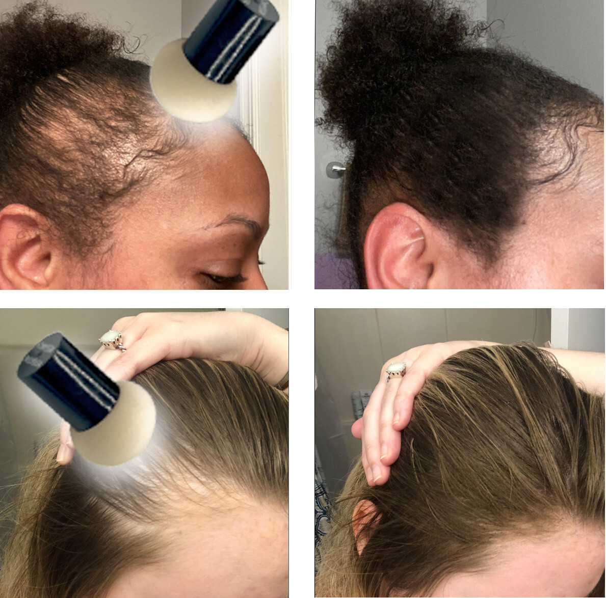 Extra Large Hairline Filler Root Touch-Up Hair loss Concealer Bald Spot Coverage