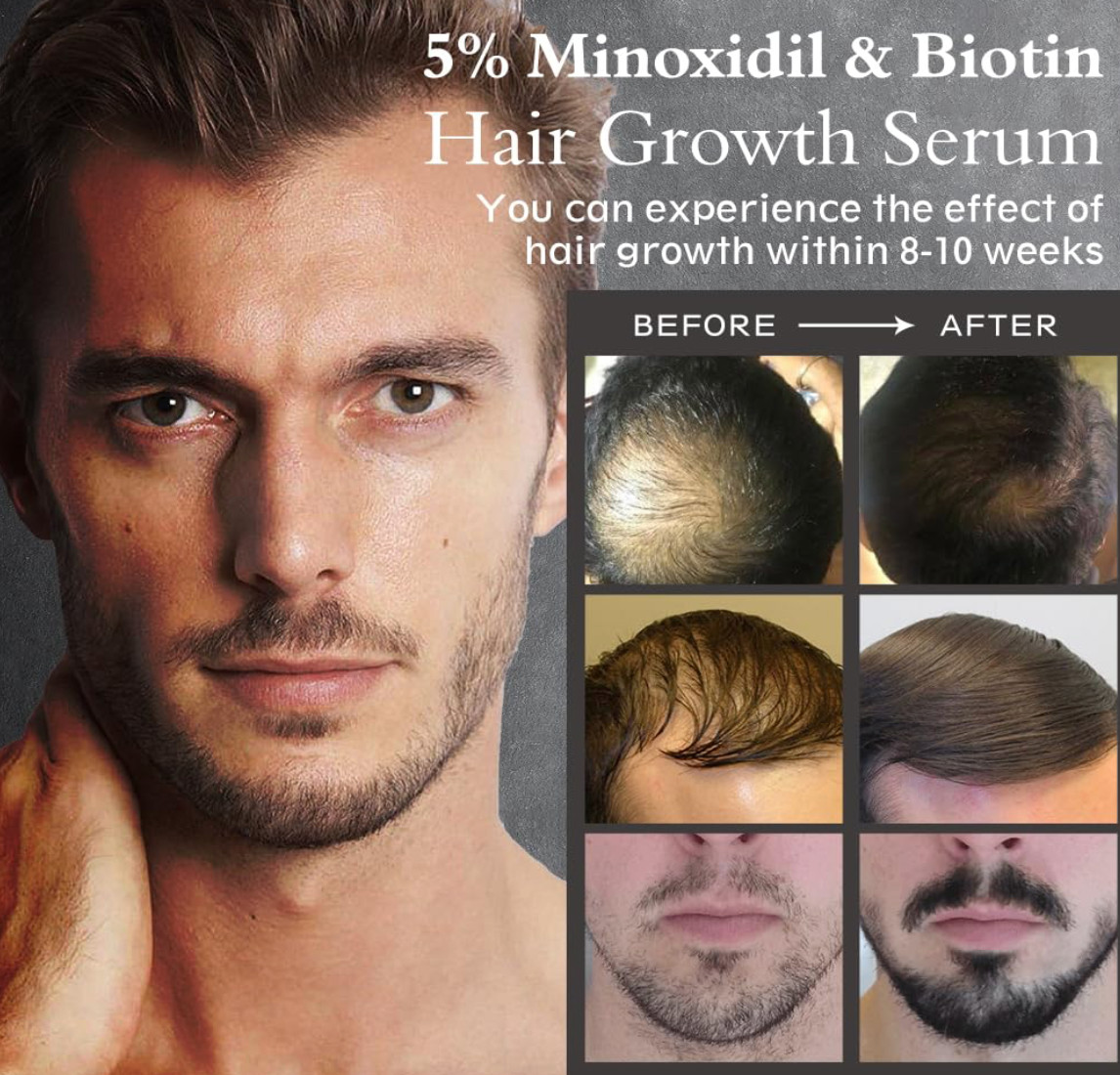 5% Minoxidil Hair Growth Serum for Men and Women, Hair Regrowth Treatment