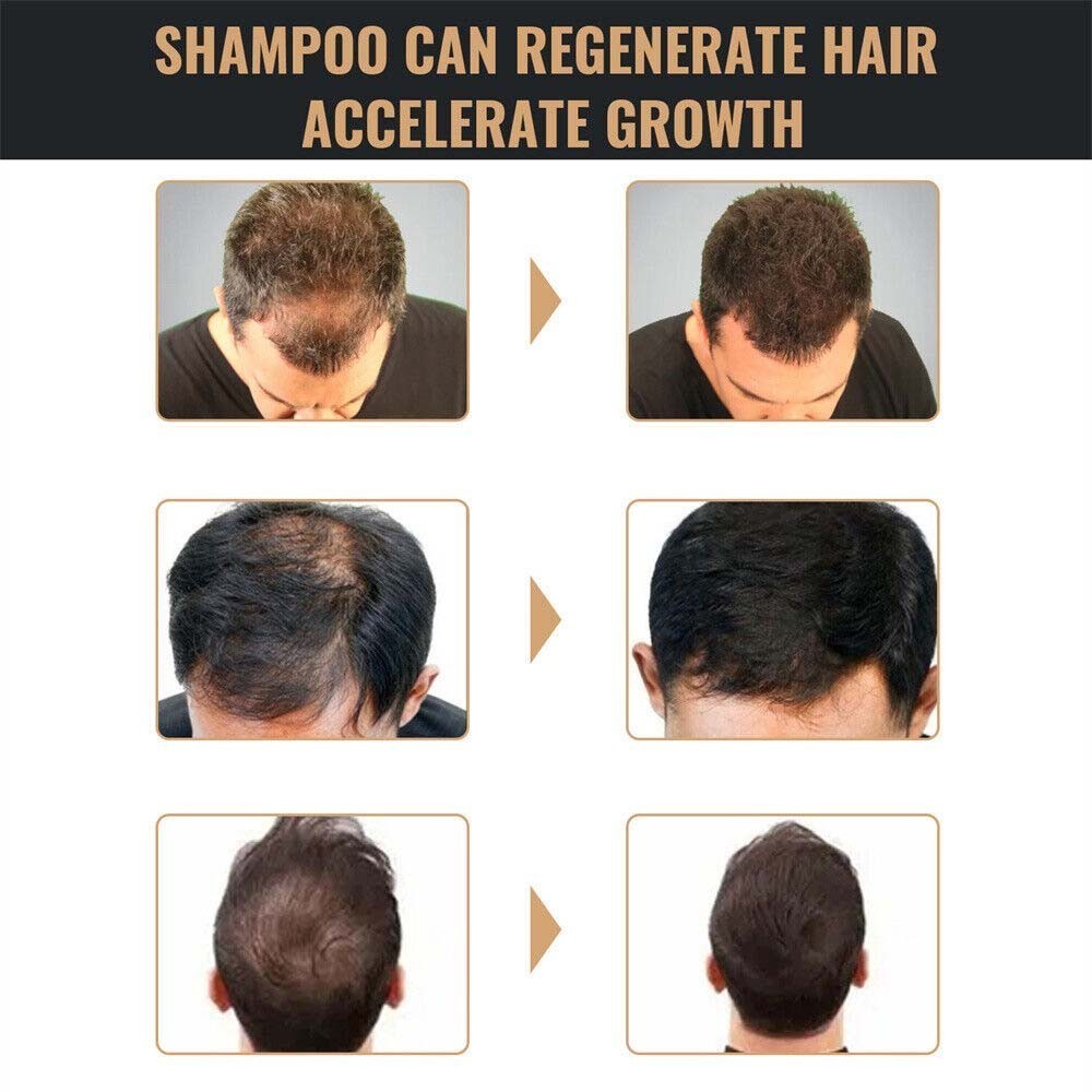 2-4X Hair Growth Shampoo Hair Regrowth Anti-Hair Loss Shampoo For Adult US STOCK