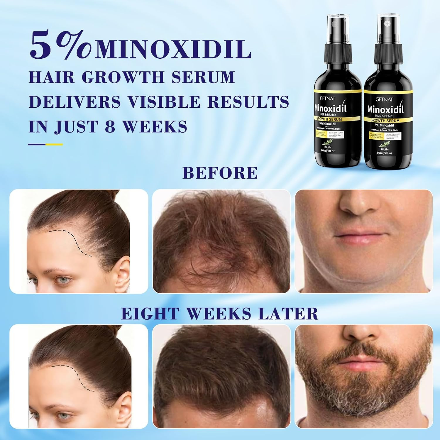 5% Minoxidil for Women with Biotin and Rosemary Hair 2 Fl Oz (Pack of 2)