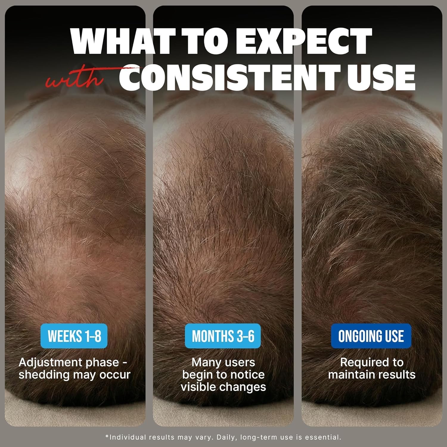 Kirkland Minoxidil 5% Hair Regrowth Treatment for Men, 6 Month Supply