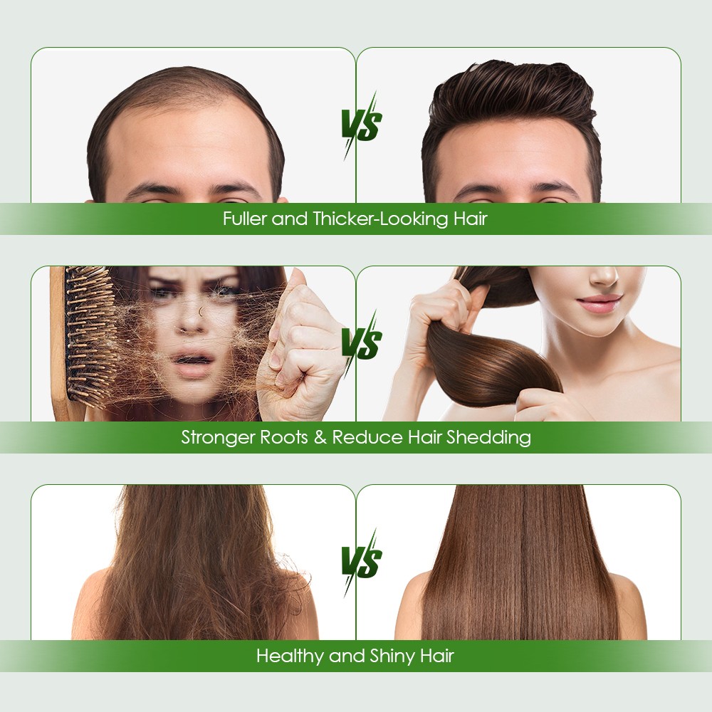 Hair Regrowth System,Advanced Alpha Infuse Microneedle Hair Regrowth Treatment