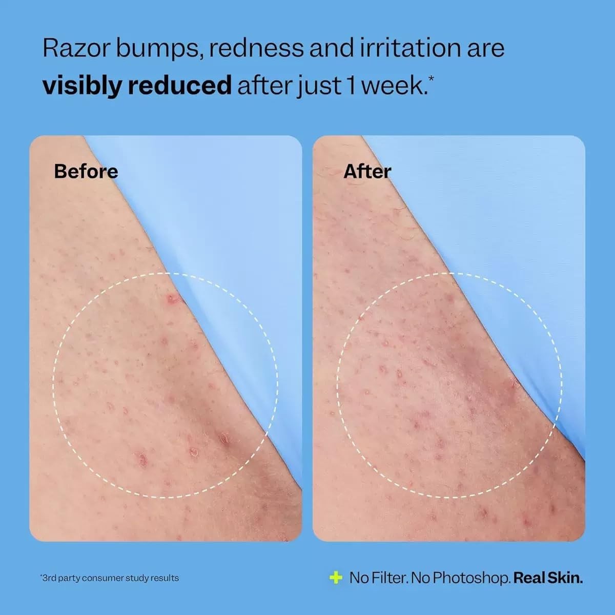 Smoothing Solution Ingrown Hair Treatment Serum for Razor Bumps and Bikini Li…