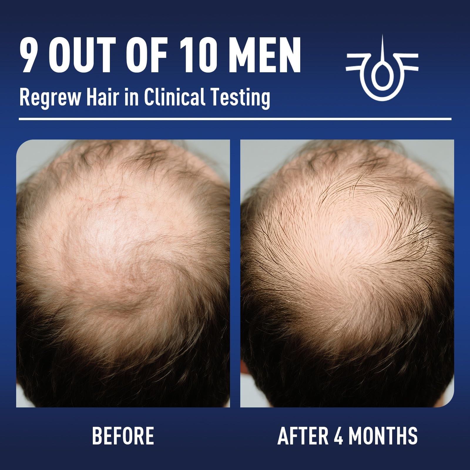5% Minoxidil & Biotin Hair Growth Treatment for Thicker Hair 8 Month Supply