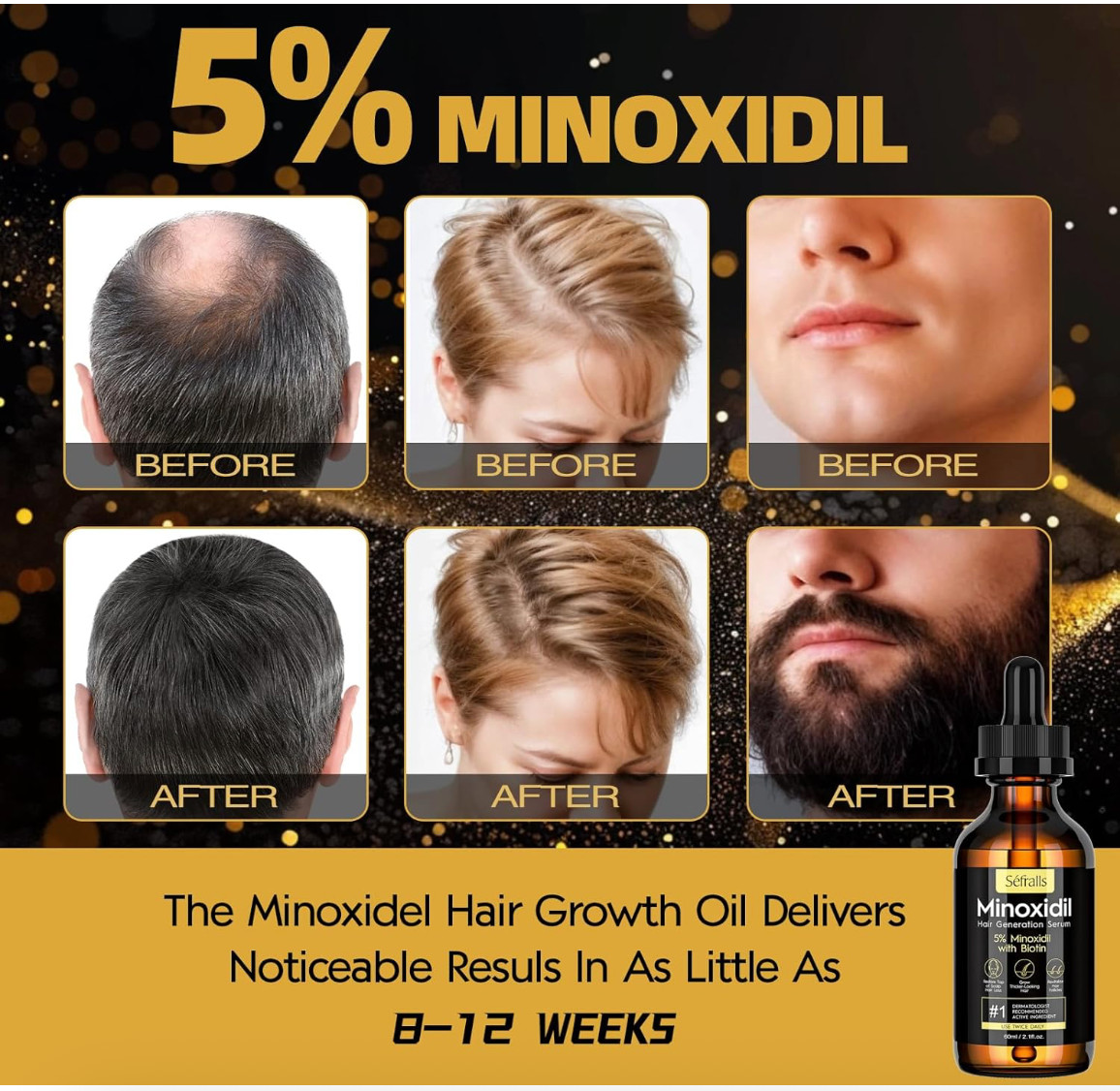 5% Minoxidil Hair Growth Serum for Men and Women, Hair Regrowth Treatment