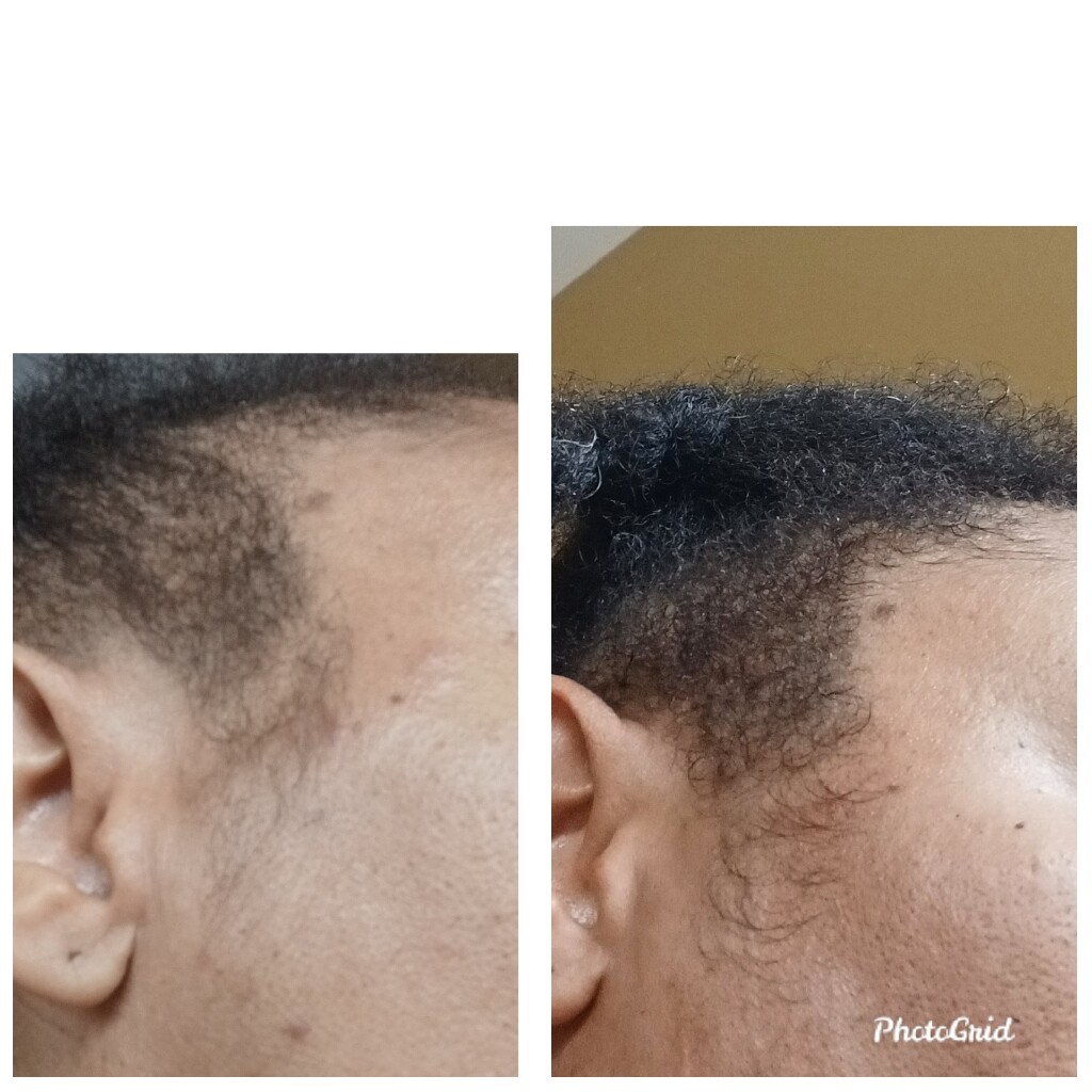 Hair Growth Oil DHT, Alopecia, Organic Nettle, Green Tea, pumpkin Seed