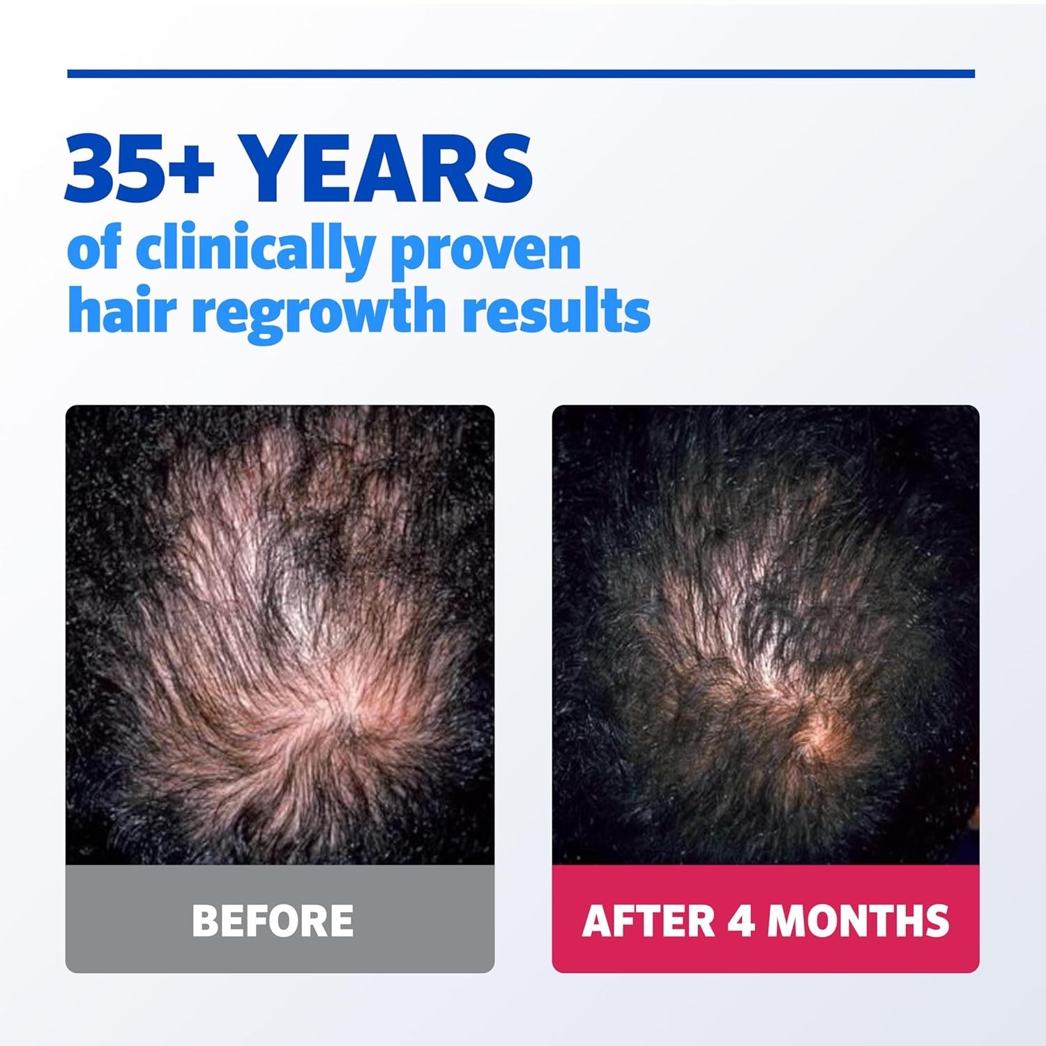 Kirkland Minoxidil 5% Extra Strength Men 6 Month EXP: 03/25 Hair Growth Solution