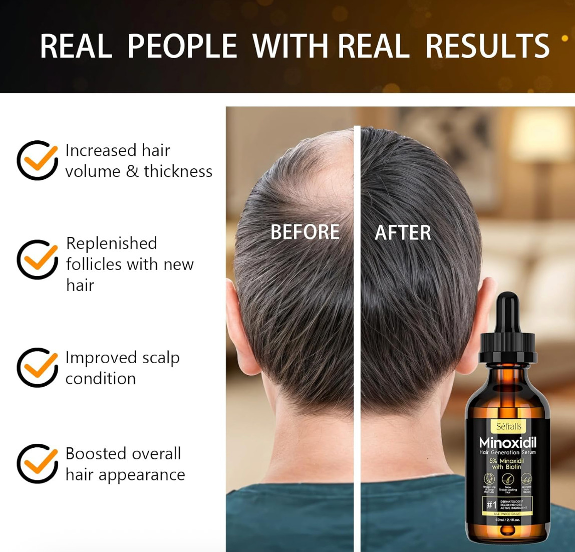5% Minoxidil Hair Growth Serum for Men and Women, Hair Regrowth Treatment