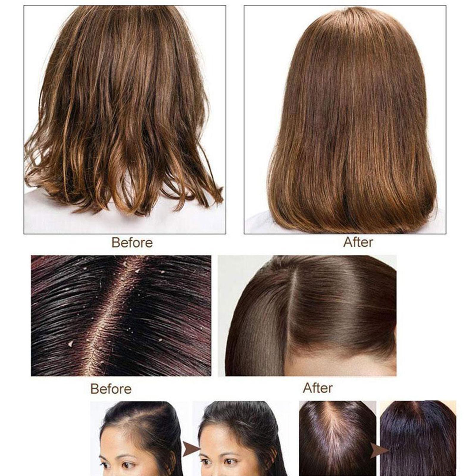 3PCS Ginger Hair Regrowth Shampoo Bar Hair Growth Soap Hair Loss Treatment USA