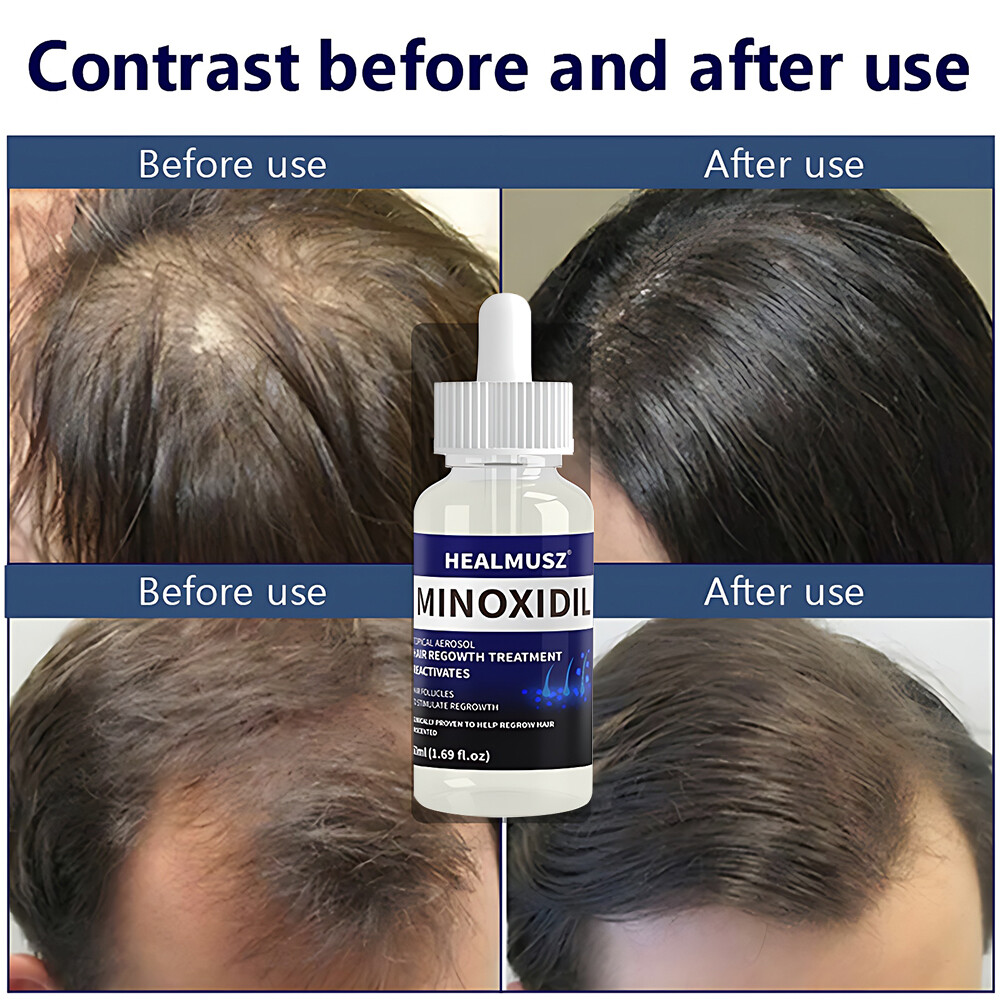 Minoxidil 5% Extra Strength for Men&Women Hair Regrowth Solution 6 Month Supply