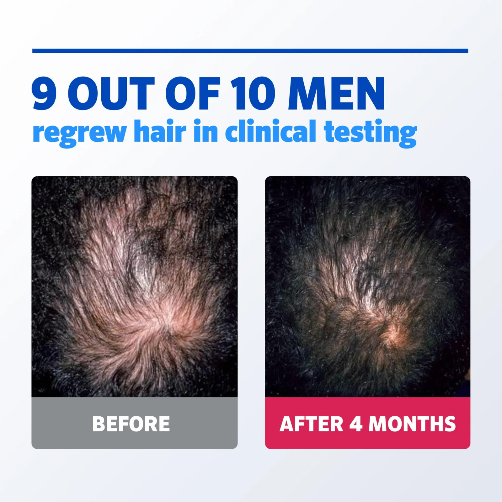 ✳️KIRKLAND Minoxidil 5% Extra Strength Men Hair Regrowth Solution 6 Month Supply