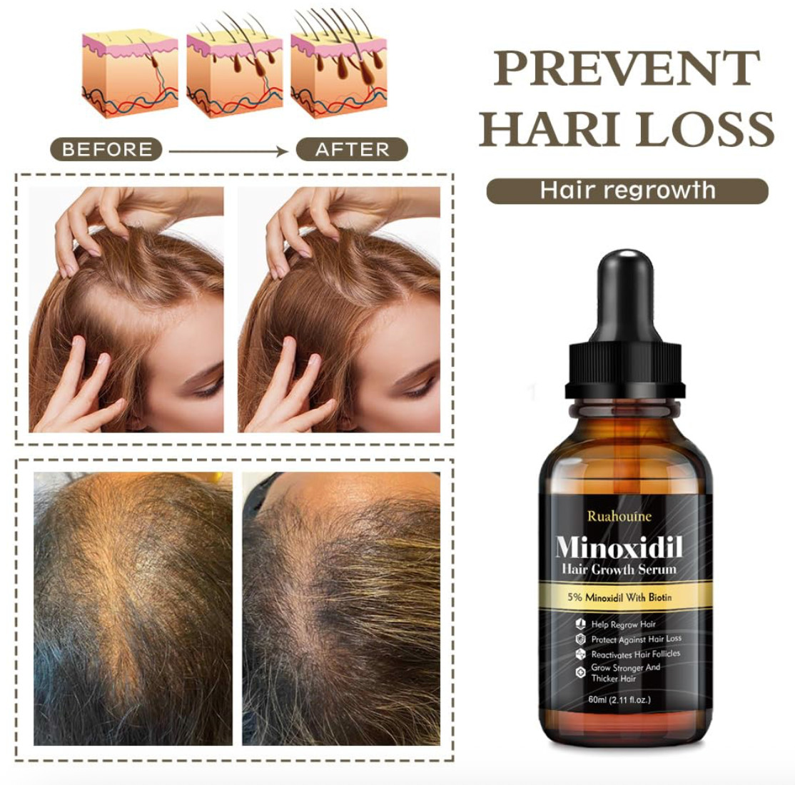 5% Minoxidil Hair Growth Serum for Men and Women, Hair Regrowth Treatment