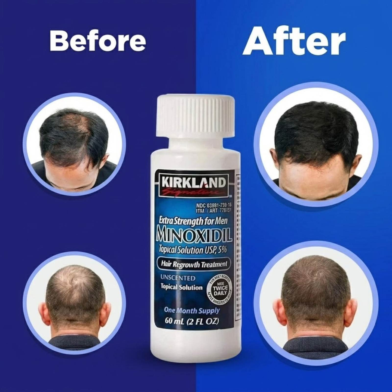 Kirkland Minoxidil 5% Hair Regrowth Treatment for Men 6 Month Supply Exp 01/29