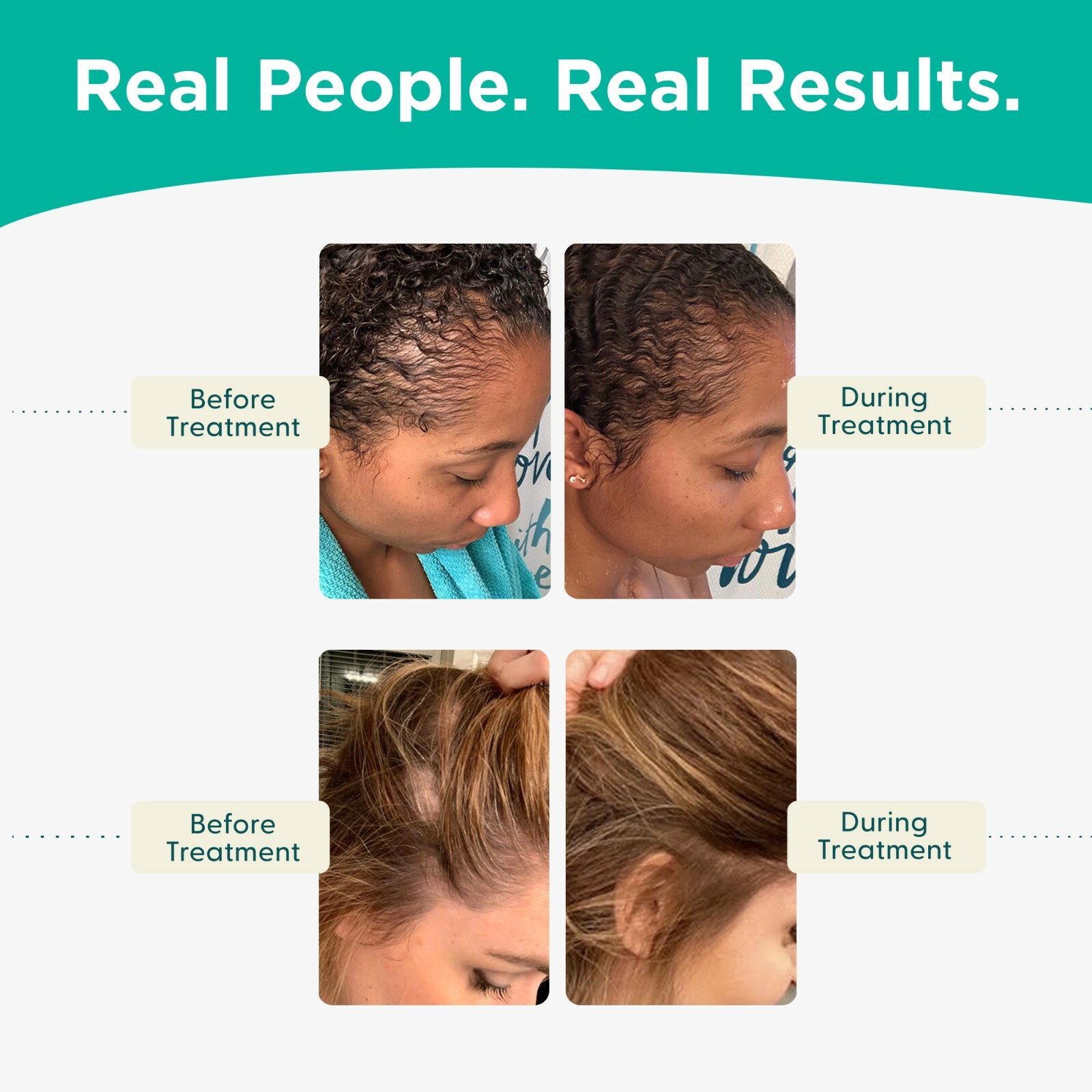 Shapiro MD Hair Loss Leave-In Daily Foam, Vegan Formula with DHT Blockers