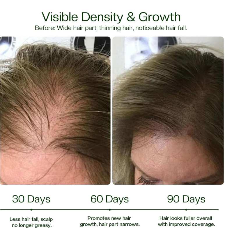 Hair Growth Spray Rosemary Oil Biotin Caffeine Castor Oil Anti Hair